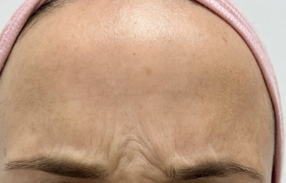 Antes