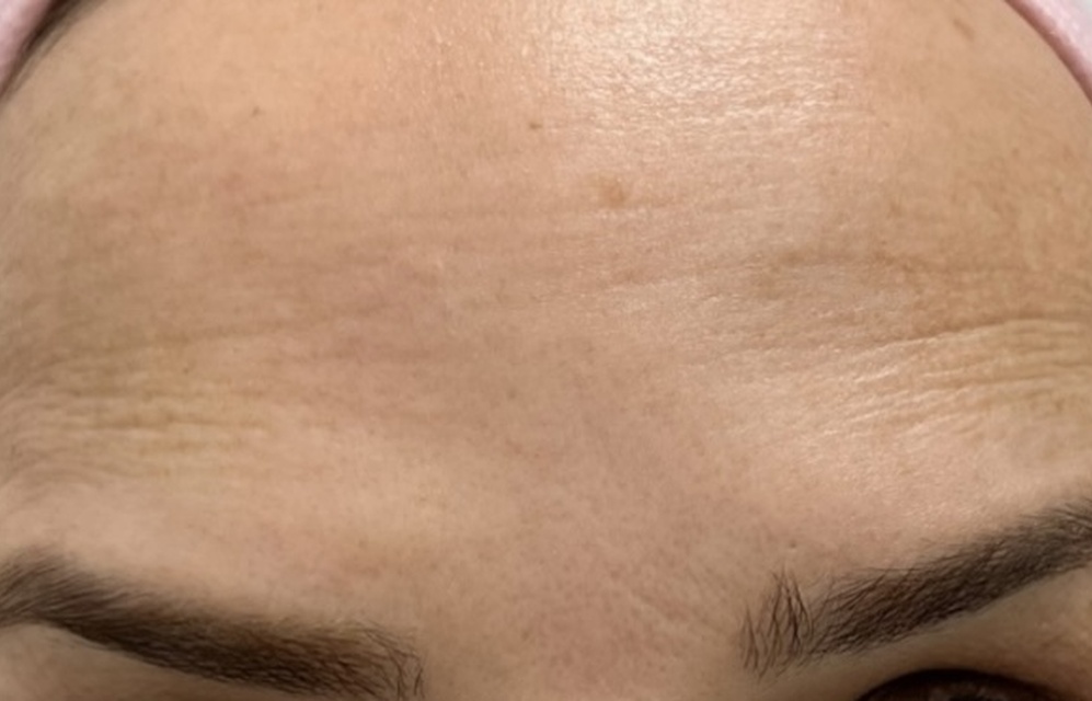 Antes