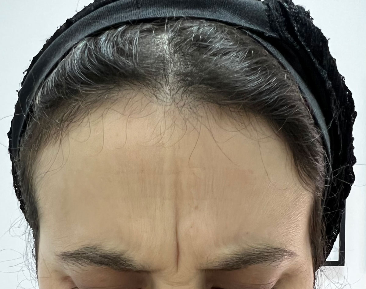 Antes